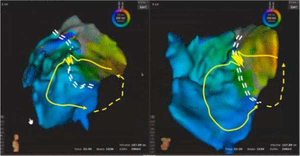 室性心律失常的新進展,你瞭解多少?|GW-ICC 2021 室性心律失常的新進展,你瞭解多少?|GW-ICC 2021