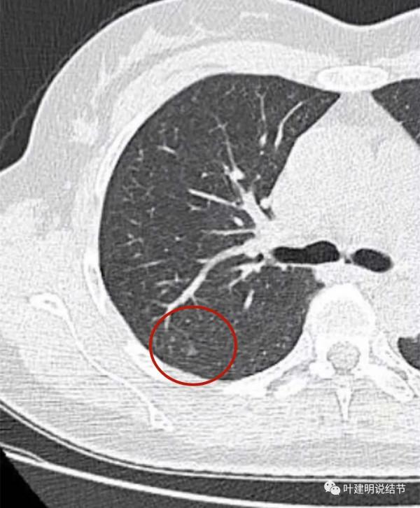 指南說小於5毫米的肺結節不需要隨訪，打臉來了