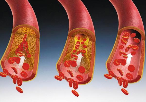 血脂高是麵條影響的？醫生建議：想平穩血脂，儘量少吃這2種食物
