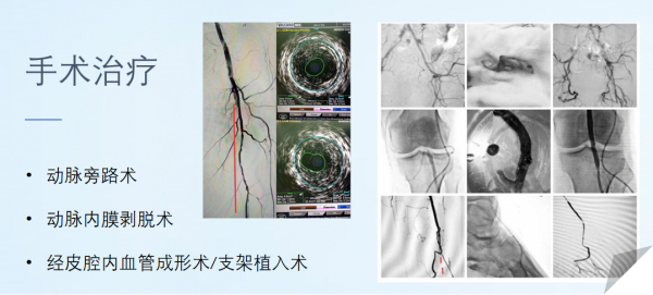 冬天腳涼?警惕血管病變 冬天腳涼?警惕血管病變