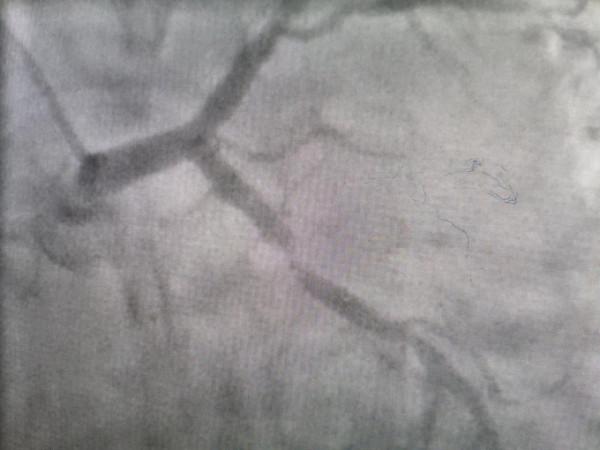 發作時胸悶背痛意識恍惚為哪般？……不一樣的心絞痛