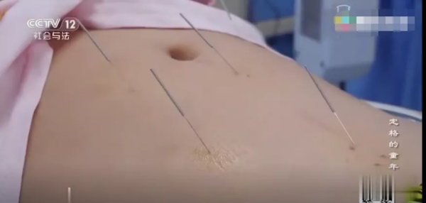 “我被‘綁’在輪椅上學習”，這一個動作，讓400+個孩子終身癱瘓