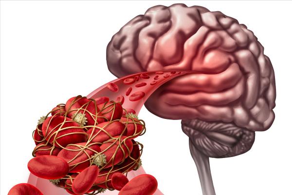 肌肉無力要注意!可能是這6種疾病 肌肉無力要注意!可能是這6種疾病