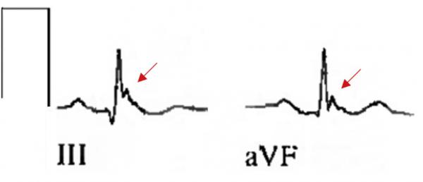 早期復極都是正常的嗎?一場驚險的心跳驟停帶來的啟示 早期復極都是正常的嗎?一場驚險的心跳驟停帶來的啟示
