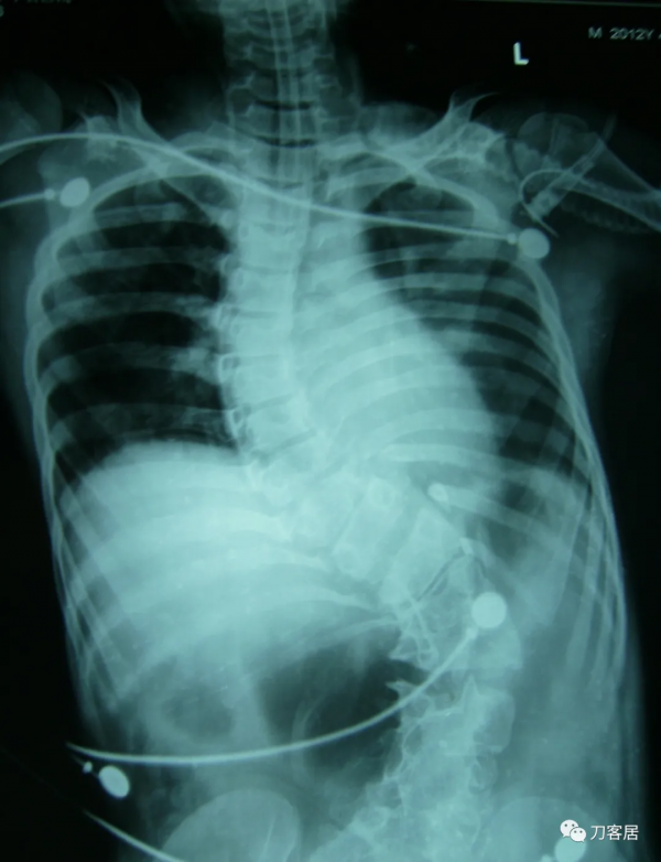 惡性高熱第3例：12歲，脊柱側彎，矯形術後死亡