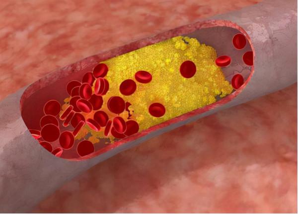 服用西地那非之前，有哪些注意事項？