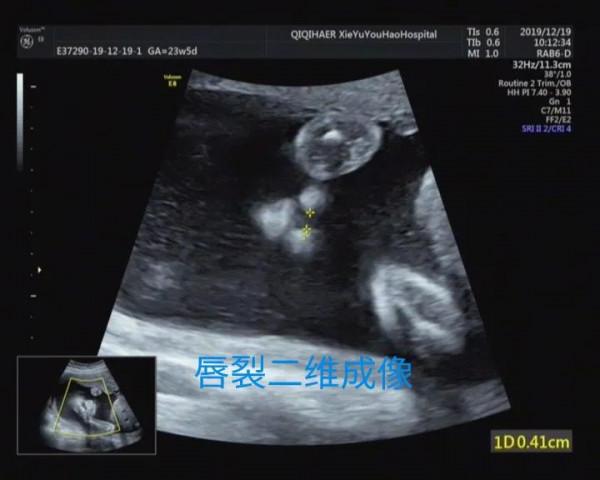 你也能看懂的胎兒畸形——病例分享 你也能看懂的胎兒畸形——病例分享