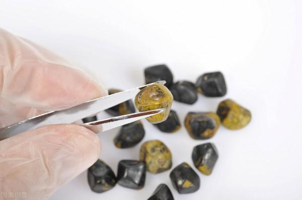 25歲小夥膽結石反覆發作，又害怕做手術，究竟該如何治療？