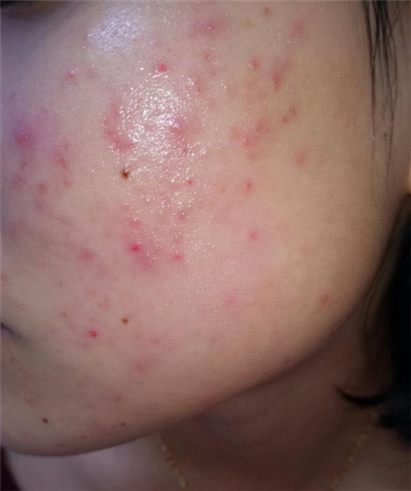 老中醫的經驗，為什麼你總是長痘痘