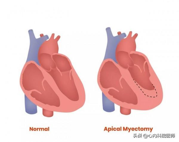 最適合老年人服用的降壓藥是坎地沙坦，醫生告訴你為什麼