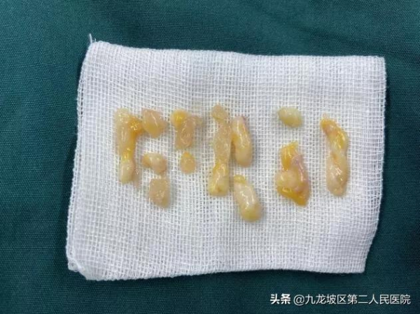不縫針、不留疤，5分鐘完成&mdash;乳腺結節病灶切除術後即可出院
