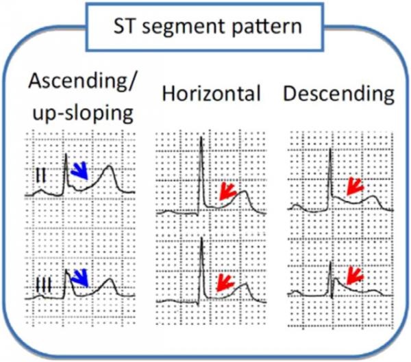 早期復極都是正常的嗎?一場驚險的心跳驟停帶來的啟示 早期復極都是正常的嗎?一場驚險的心跳驟停帶來的啟示