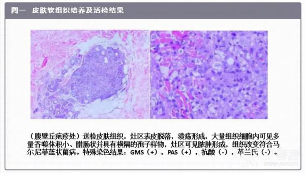 女子胸痛、咳嗽,主診醫師考慮肺癌準備手術,主任會診後:誤診了 女子胸痛、咳嗽,主診醫師考慮肺癌準備手術,主任會診後:誤診了