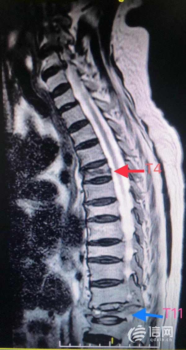 高齡患者遭遇車禍 平度市人民醫院微創手術恢復健康