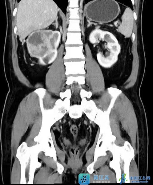 6科專家聯手手術 江蘇省人醫：複雜手術由專業團隊攜手完成
