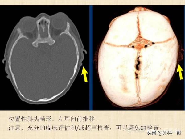 小兒顱縫早閉的診斷治療