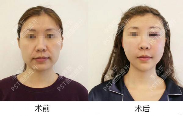 「案例分析」49歲的李女士，PSV面部提升後，脖子怎麼也變長了？