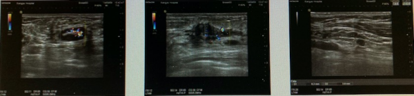 愈見未萊 | 恩美曲妥珠單抗助力HER2+早期乳腺癌患者的生存率再上新臺階