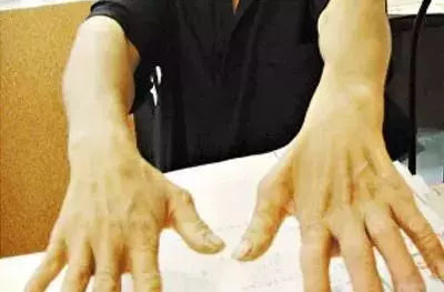 手部無力,上肢萎縮,手掌呈爪狀?醫生提醒:警惕“平山病” 手部無力,上肢萎縮,手掌呈爪狀?醫生提醒:警惕“平山病”