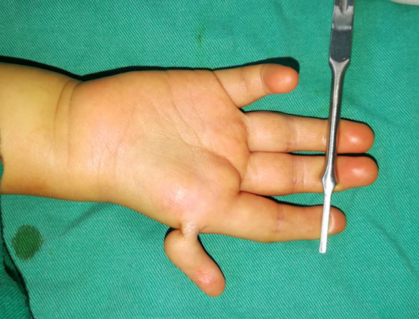 漂浮拇半掌骨移植重建手術為什麼需要做兩期？