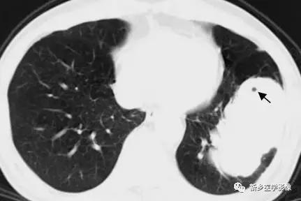 肺部5大基本病變,影像診斷的基礎 肺部5大基本病變,影像診斷的基礎