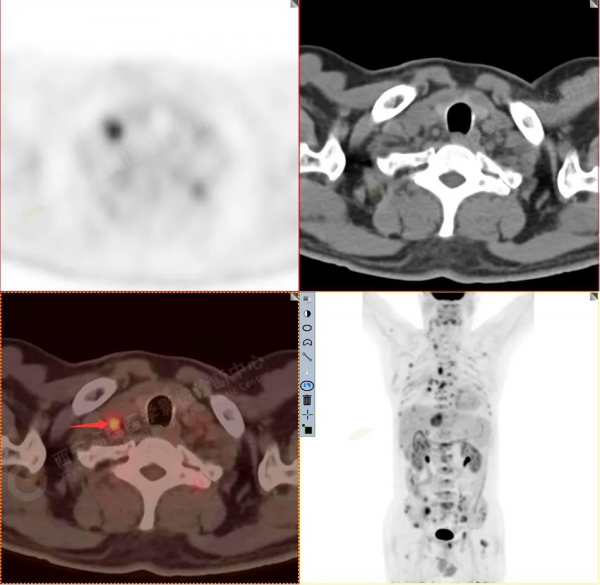 肺結節看診（13）：肺小結節全身廣泛轉移2例，PET分期：晚期