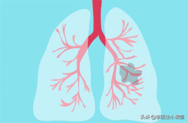 如何讓你的肺結節變小或者消失? 如何讓你的肺結節變小或者消失?