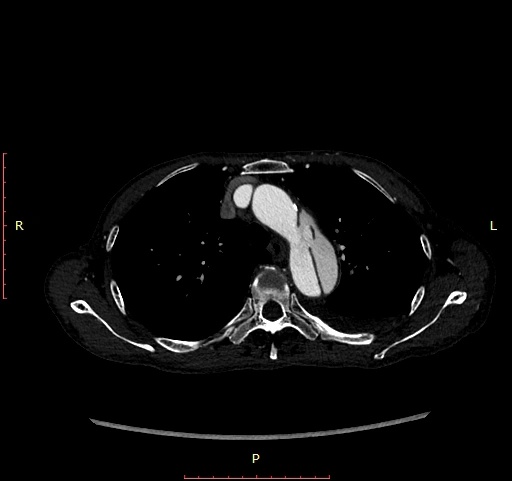 北京同仁醫院血管外科成功開展首例主動脈支架“開窗”術 北京同仁醫院血管外科成功開展首例主動脈支架“開窗”術