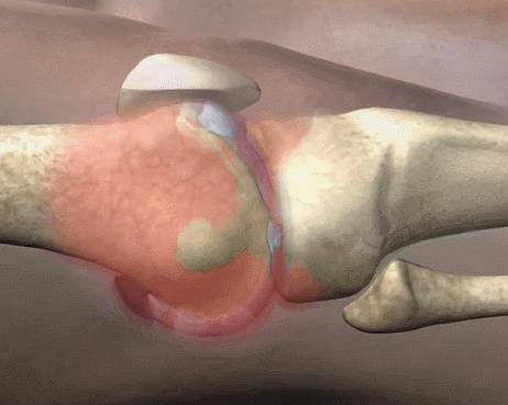 4位不同疾病患者的自述:幹細胞技術讓我們擁有了全新的生活 4位不同疾病患者的自述:幹細胞技術讓我們擁有了全新的生活