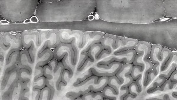 他們用人類史上最強的X光，告訴我們新冠患者的肺傷成了什麼樣