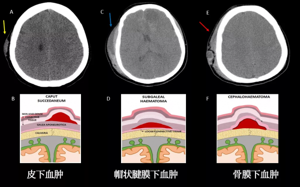 頭皮和顱骨病變的影像學特點 頭皮和顱骨病變的影像學特點
