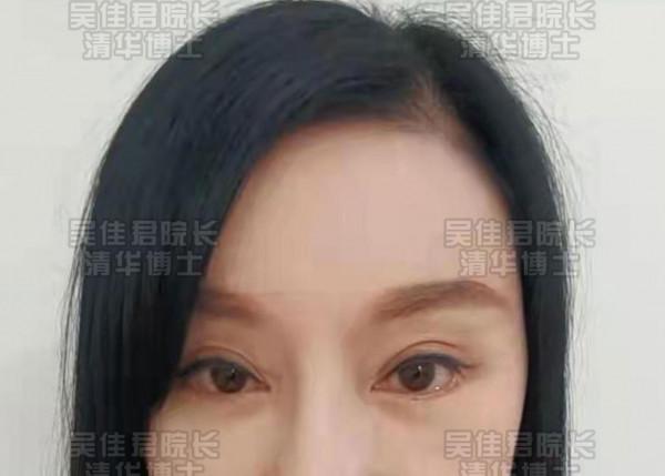 額頭提升後的她們，沒了抬頭紋、川字紋，眼睛也更有神了