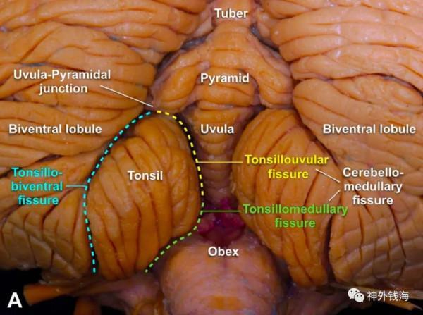 一例腦幹海綿狀血管瘤的手術陷阱