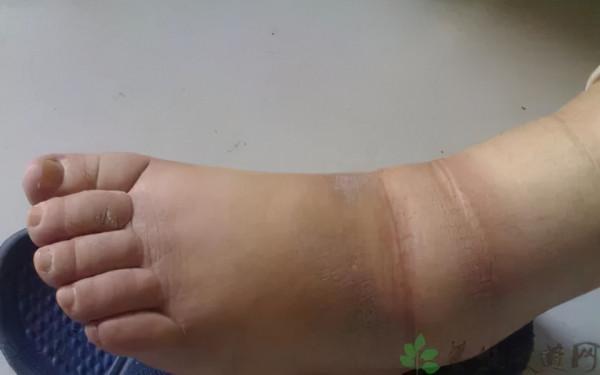 下肢腫脹好似大象腿,到底怎麼回事? 下肢腫脹好似大象腿,到底怎麼回事?