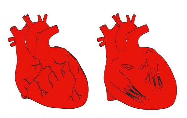 出現心臟早搏，感覺心臟在“狂跳”，有生命危險嗎？