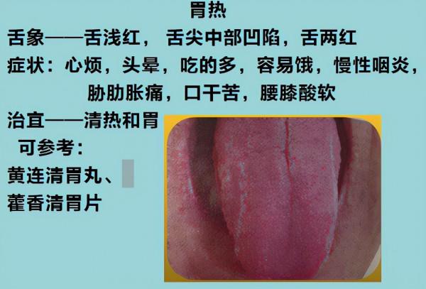 9種“熱”藏於體內，不同舌象，不同症狀，看看你是屬於哪一種