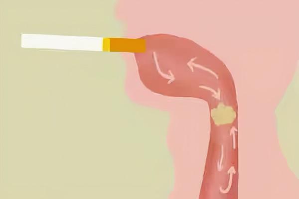 吐出的痰液顏色不同說明了什麼？黑痰、黃痰、白痰，哪個更嚴重？