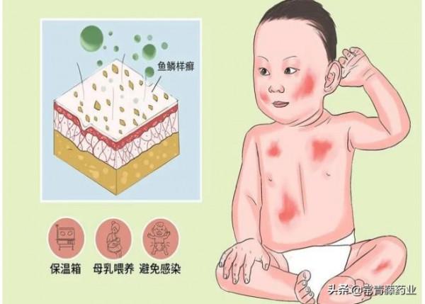 罕見火膠棉樣嬰兒被成功救治，此病有多恐怖？只有10%可恢復正常