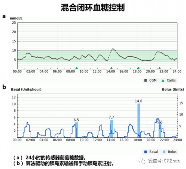 臨床內分泌未來篇 &vert; 2021新閉環胰島素系統-感測器、胰島素泵和控制系統