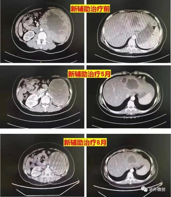 南昌大學二附院泌尿外科胡紅林教授團隊完成一例轉移性腎癌新輔助治療後減瘤手術