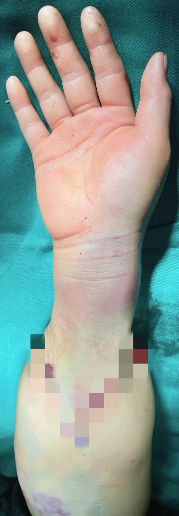 6小時徹夜奮戰保肢成功——北京積水潭醫院手外科完成2022年首例斷肢再植手術