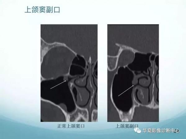 頭頸五官CT斷層解剖圖及常見病影像診斷