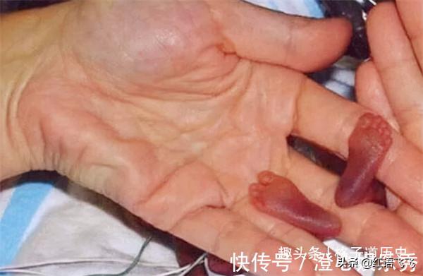 14年前,那個打破吉尼斯世界紀錄的“拇指寶寶”,後來怎麼樣了 14年前,那個打破吉尼斯世界紀錄的“拇指寶寶”,後來怎麼樣了