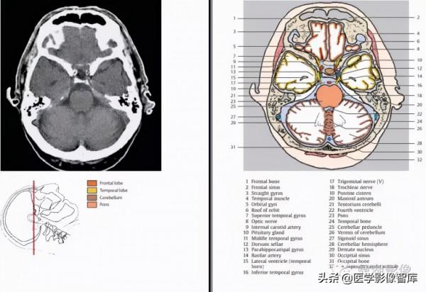 CT斷層解剖圖譜最全總結「推薦收藏」 CT斷層解剖圖譜最全總結「推薦收藏」