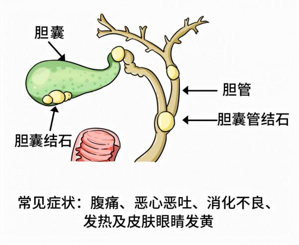 結石發作時生不如死!若不想被“纏上”,建議收藏這份防控指南 結石發作時生不如死!若不想被“纏上”,建議收藏這份防控指南