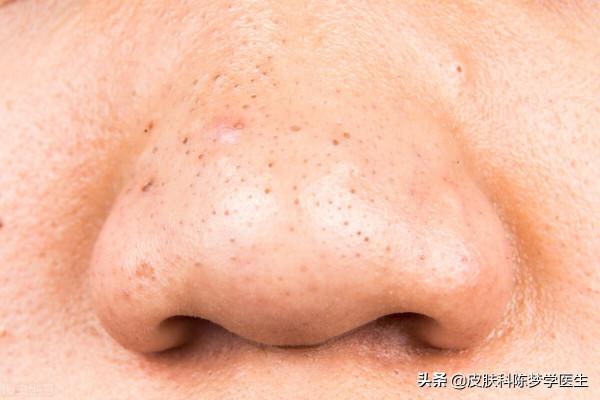 長粉刺、毛孔粗大都可以用它—維A酸乳膏 長粉刺、毛孔粗大都可以用它—維A酸乳膏