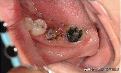 不痛不用拔?這些殘根危害可不小,嚴重要截骨 不痛不用拔?這些殘根危害可不小,嚴重要截骨