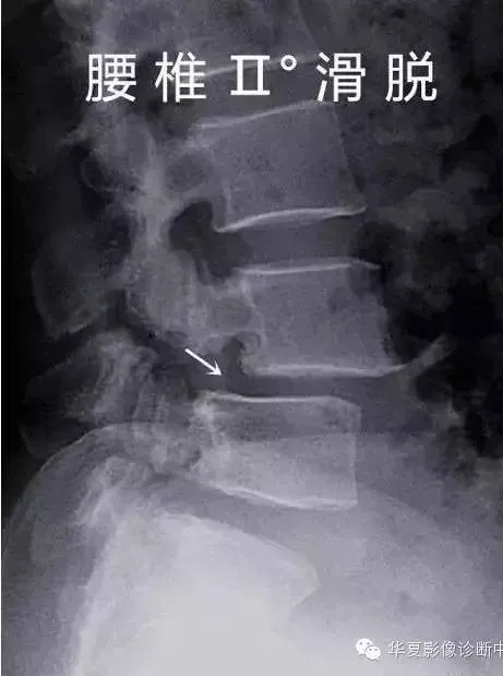 骶椎腰化/腰椎骶化、腰椎滑脫、腰肌勞損，簡單易懂圖解