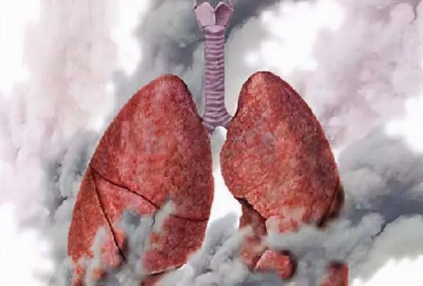慢阻肺吃這種藥最有效