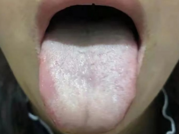 痰多難除?中醫:善治痰者,不治痰而治氣,用治氣法掃除全身之痰 痰多難除?中醫:善治痰者,不治痰而治氣,用治氣法掃除全身之痰